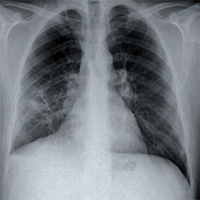 Lambda sign on a gallium scan: not always sarcoidosis ...