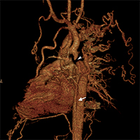 Three-dimensional reconstruction of the CT aortogram showing a short segment complete interruption of the aortic arch (white arrowhead) just distal to the origin of left sub-clavian artery along with the presence of a linear intimo-medial flap (white arrow) in the descending aorta distal to the interrupted segment